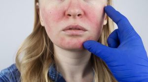 Soothing Solutions To Rosacea